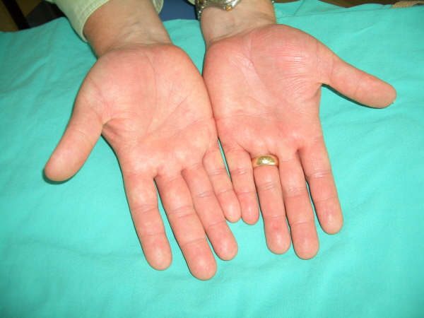 Palmoplantar pustular psoriasis image