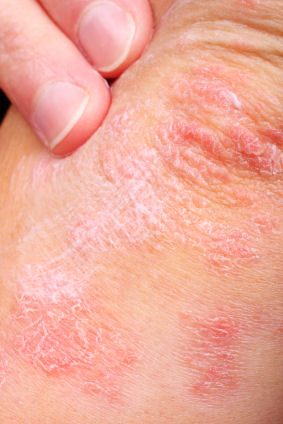 Plaque Psoriasis On the Elbow