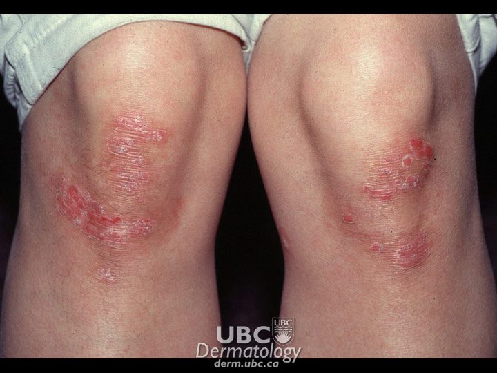 psoriasis on knees picture